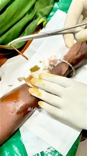 I took out the splinter from inside my hand. #foreignbodyremoval #ataur #healthtips