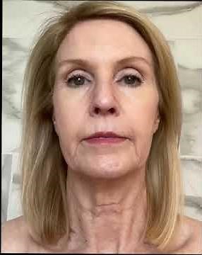 Deep Plane Facelift Before and After Transformation #deepplanefacelift