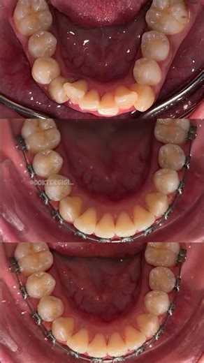 Lower arch transformation in progress. #orthodontics