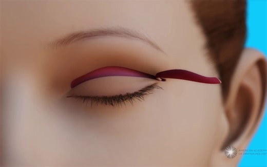 医学动画 - 眼睑整形术