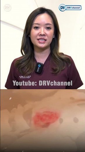 Ulkus Kulit. Penyebab, Gejala, Pencegahan, dan Penanganannya #DRV #UlkusKulit #Vena
