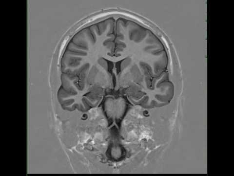 Mesial Temporal Sclerosis, Right
