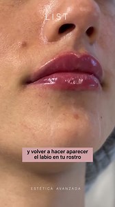 33K views · 5.7K reactions | ¡Busquemos juntos tu labio ideal! Pedí tu turno al 011 15-3445-0278 y visitanos en cualquiera de nuestras dos sucursales: Av. Santa Fe 3312 (Palermo) Av. Cabildo 642 (Belgrano) | Centro Medico List | Facebook
