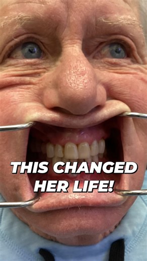 Her brittle teeth forced her to make a life-changing decision... 🥺🦷 Have you ever had to make a tough choice because of your health? 🤔 Discover her journey and how this decision transformed her life. 🌟 #dentalimplants #beforeandafter #dental #trending #fyp #SmileMakeover #newsmile #trendingreelsvideo #BeforeAndAfter | Nuvia Dental Implant Center