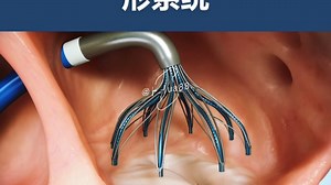 VALFLX-二尖瓣成型系统