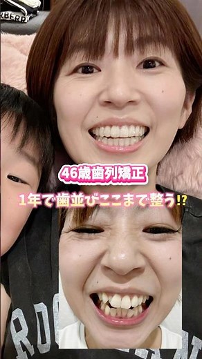 1年間でここまで変化！【矯正ビフォーアフター】#矯正ビフォーアフター #歯列矯正 #矯正記録 #マウスピース矯正 #大人の矯正 #歯並び改善 #インビザライン #矯正女子