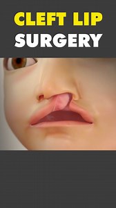 Cleft Lip Repair Surgery 3D Animation #cleftliprepair #cleftliprepairsurgery #cleftliprepairtransformation #cleftlip #cleftlipsurgery #cleftlipsurgerydone #liptreatment #lipsurgery #medical3danimatio | Surgery Page | Facebook
