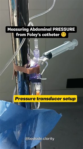 Dr. Ankit Goyal, MD | How do we measure Intra-Abdominal Pressure (IAP) without inserting anything into the abdomen? We use the bladder. Yes — the bladder becomes... | Instagram