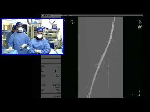 Transradial Access for Above the Knee (SFA) Angioplasty and Stenting