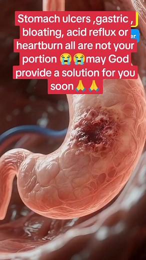 Stomach Ulcer & H. Pylori Relief: Natural Solutions