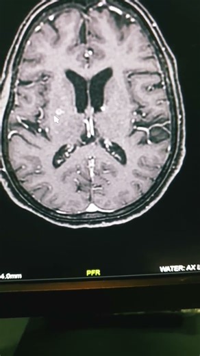 Brain caseating tuberculomas:ring enhanced lesions /black centers T2 & bilat. big Adrenal necrosis.