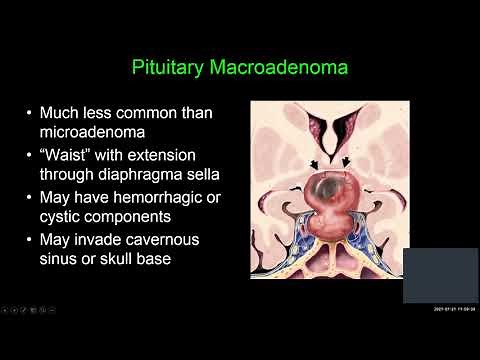 Sellar, Suprasellar and Parasellar Masses w/Dr. Shatzkes 7/21