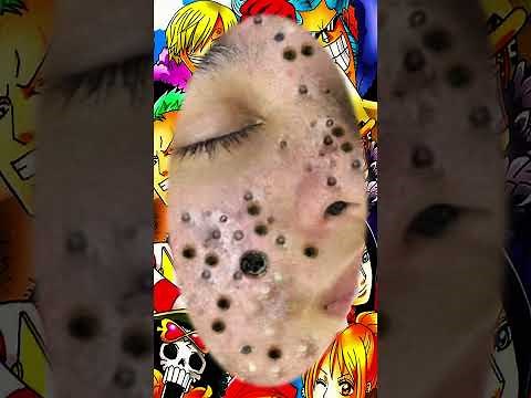 Blackheads Removal | old aged blackheads removal/ cystic blackheads whiteheads removal
