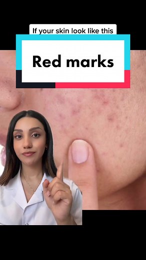 Best Products for Post Inflammatory Erythema: Azelaic Acid for Acne Scars