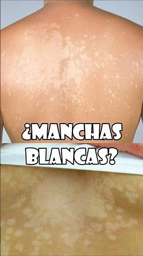 White spots that don't tan