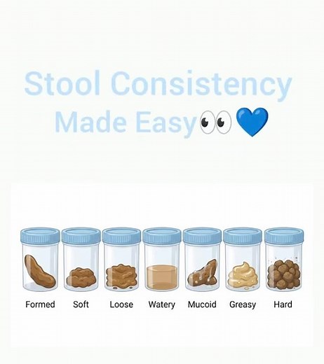 Stool Consistency Made Easy 🧪| Stool & Disease Diagnosis | Medical Lab Technology Must Watch #viral