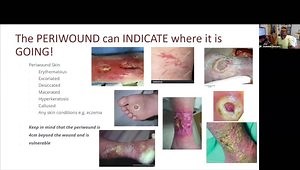 When Skin is a Spectrum of Color-Wound Assessment and Staging of Pressure Injuries