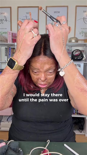 This was a recurring “dream” I had while I was in my coma. It was because the pain of debridement on my chest was so great that I felt it through the coma. I had no idea that my body was laying in a hospital bed fighting for my life. It felt like I was in another world, but I was looking for my kids. They were the only thing I remembered from this world. Be good to each other.🦋 Love y’all!😘 📺 Full LIVE replay available on my YouTube BurnedBeauty2018 #burnsurvivor #domesticviolencesurvivor #na