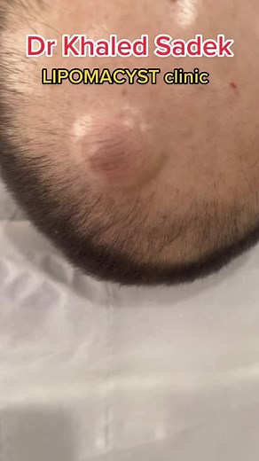 Professional Pilar Cyst Removal and Lipoma Extraction at LIPOMACYST Clinic