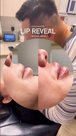 😍Loving this Lip Before & After 😍 #lips #lipfillers #lippies #lipinjections #filler #fillerlips 💋