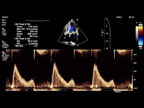 [Echo Case Review] Post Mitral & Tricuspid Valve Repair with Mild Diastolic Dysfunction | Echo Case