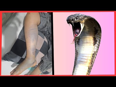 Emergency first aid for Snake bites in children - WHAT to do & WHAT not to do