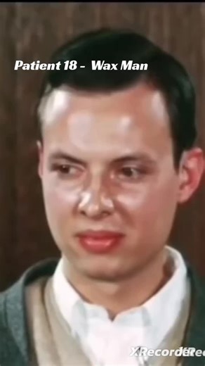 #patient 18 #waxman #catatonic schizophrenia documentary # | schizophrenic
