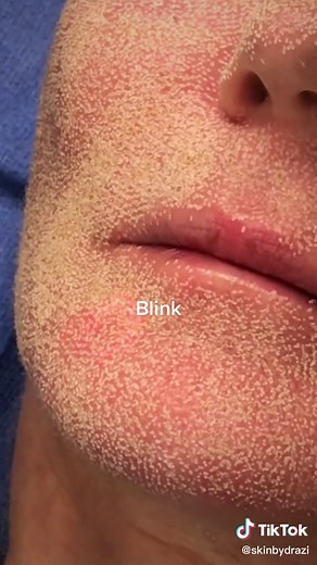 Skin Transformation with CO2 Laser Resurfacing