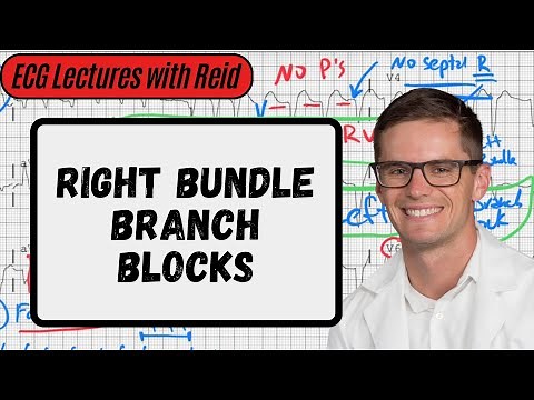 Right Bundle Branch Blocks | Day 9 ECG Challenge
