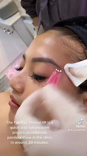 The Fox-Eye Thread-lift is a quick, non invasive, no downtime, relatively pain free procedure.#foxeye #thread#facial #gucchieclinic