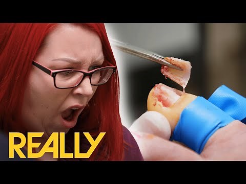 Treating A Fungus Means Removing The Whole Nail! | The Toe Bro