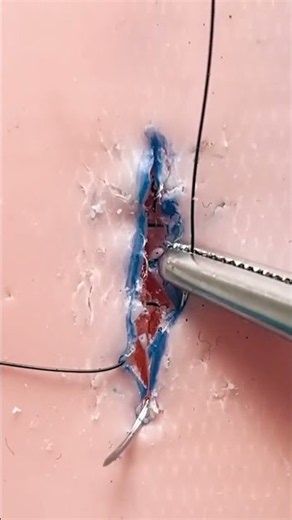 Running subcuticular suture