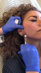 Jawline contouring with restylane