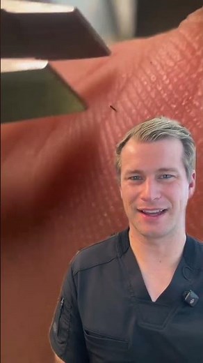 Huge splinter removal! #huge #dermatology #splinter