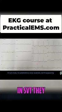 ECG Secrets: Spotting WPW and Delta Waves for Palpitations! #shorts