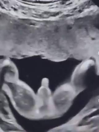 Penis size is set before birth by maternal health, metabolism, and hormone exposure (including birth control)Penis size is largely determined during fetal development through the maternal–placental endocrine system.Masculinization depends on DHT acting locally in genital tissue. Fetal circulating DHT is often very low, which shows that the androgenic signal is generated inside tissues from precursors rather than delivered directly through blood.A major part of this signal comes from the backdoor