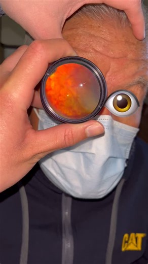 Jorge Saucedo on Instagram: "What’s your diagnosis? 70 year old male History of systemic hypertension Present with diminished visual acuity 3 weeks prior to the consultation Visual acuity is 20/400 on snellen chart Anterior segment is unremarkable Fundus exam shows flame hemorragias throughout the entire retina and hard exudates on the macular area The OCT depicts a cystoid macular edema. What other study would you ask for in order to make a proper diagnosis What treatment would you start. #opht