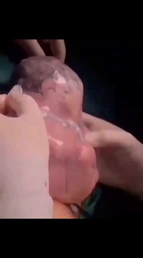 DR.KARISHMA on Instagram: "The miracle of a rare delivery - born without amniotic fluid ! This baby born while still encased in a fully intact amniotic sac and without amniotic fluid. The amniotic fluid is part of the baby’s life support system. It protects your baby and aids in the development of muscles, limbs, lungs and digestive system. Amniotic fluid also contains vital components, such as nutrients, hormones, and infection-fighting antibodies. Amniotic fluid also provides room for the baby