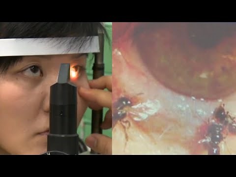 4 Bees Found Living in Woman's Eye