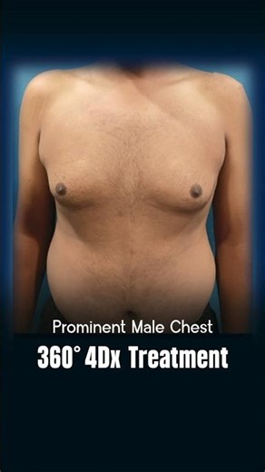 360⁰ 4DX Technique Gynecomastia Surgery in Delhi Before And After #shorts