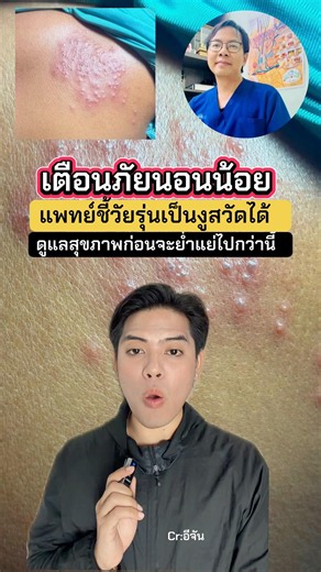 เตือนภัยสายนอนน้อย ! แพทย์ชี้ “ วัยรุ่นก็เป็นงูสวัดได้ ” #1นาทีลีเช็ค #งูสวัด #สุขภาพ #นอนน้อย