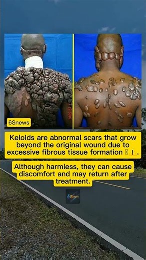 What Is a Keloid Scar?