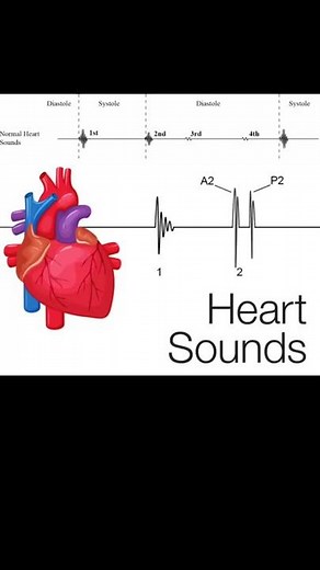 Normal Heart sounds and murmur Auscultation, mitral valve stenosis, murmur of heart in diastole