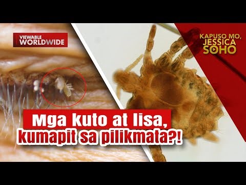 Mga kuto at lisa, kumapit na rin sa pilikmata ng isang pamilya sa Quezon?! | Kapuso Mo, Jessica Soho