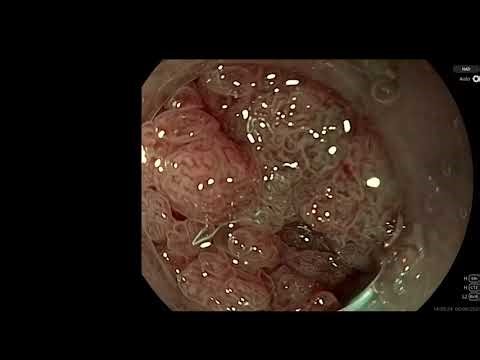 Overview and review of the new suretrac system