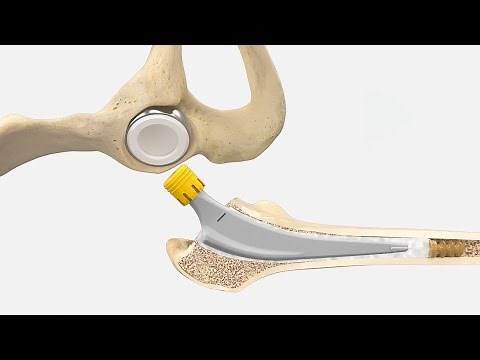 AESCULAP® Bipolar Cup & Excia® T Cemented