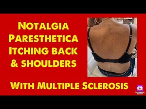 Notalgia Paresthetica - Itching back & shoulder with Multiple Sclerosis
