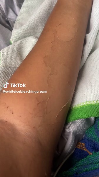 Effective Skin Whitening with Bleaching Creams