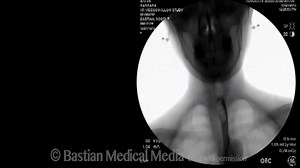 吞到胃里的X影像 Barium Swallow