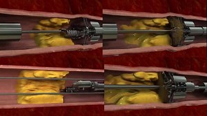 111K views · 607 shares | new technology in opening an...